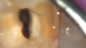 Лечение канала зуба с нестандартной анатомией.