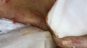 Suri Series 01: AMAZING INFLAMED BLACKHEADS POPPING | PART 4