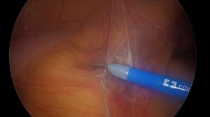 Передняя резекция прямой кишки с комментариями