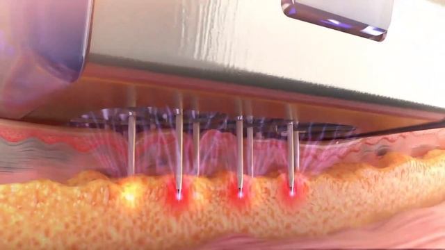 Morpheus8 London - Harley Street смотреть онлайн