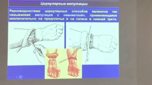 Ампутации и экзартикуляции конечностей.