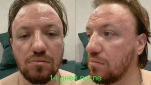 Лазерная шлифовка рубцов постакне Интервью пациента №18