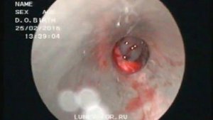 Микрогайморотомия удаление полипа верхнечелюстной пазухи и хоанального полипа25022016