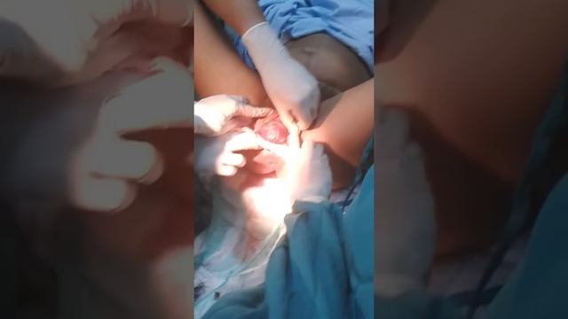 óbito fetal de 28 semanas de gestación смотреть онлайн