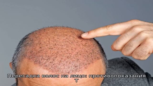 Как проводится пересадка волос на бороду и на лицо? смотреть онлайн