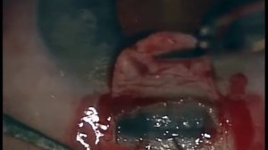 НГСЭ - непроникающая глубокая склерэктомия с имплантацией дренажа  "Ксенопласт"