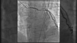 Стентирование после перенесенного инфаркта