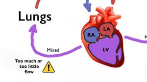 Single Ventricle Heart Defect and Treatment Explained - DILV