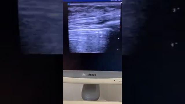 ФИБРОАДЕНОМА МОЛОЧНОЙ ЖЕЛЕЗЫ!!! смотреть онлайн