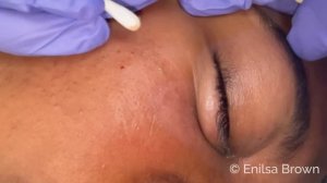 Blackhead Extractions on Netty - Sixth Treatment