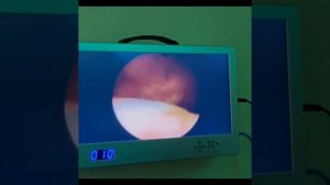 Диагностика заболеваний мочевого пузыря путем внутренней оптической смотровой цистоскопии