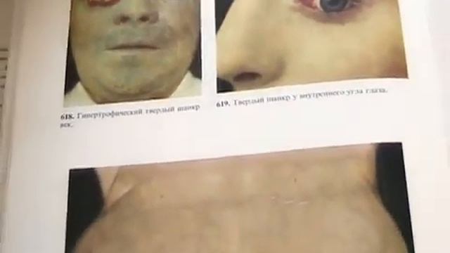 Сифилис. Интервью со специалистом смотреть онлайн