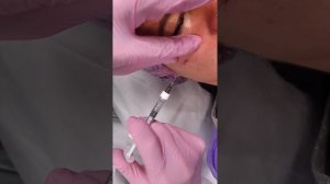 Аугментация скул филлером FEEL DERLI STRONG