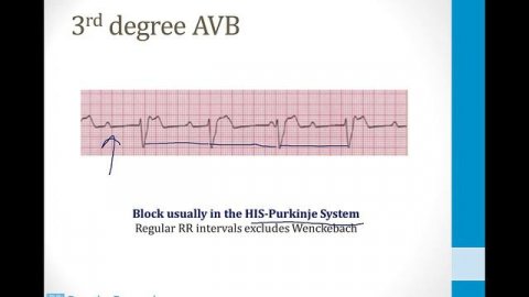 Cardiology - 4. Arrhythmias - 2.AV and Bundle Branch Blocks atf