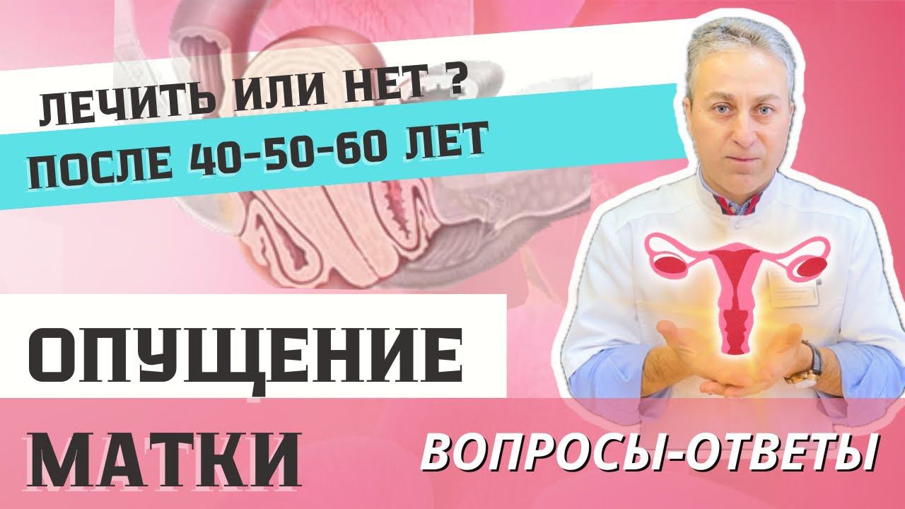 ОПУЩЕНИЕ МАТКИ у женщин ПОСЛЕ 40-50-60 лет. Как Избежать Опущения Матки После Родов?