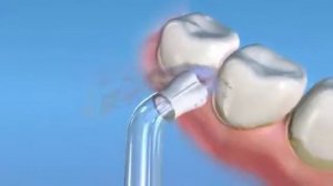 Насадка ирригатора для имплантатов.