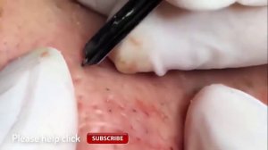 УГРИ ПРЫЩИ НА ЛИЦЕ! ДАВЛЮ Как избавиться от черноголовых ! How to get rid of blackheads3