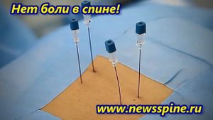 Радиочастотная денервация