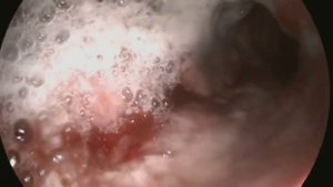 ЭГДС Рак Пищевода и Желудка (et esophageal cancer stomachi)