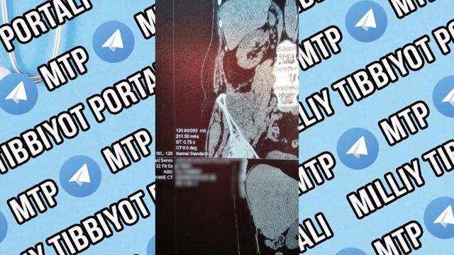 Опухоль забрюшинного пространства на компьютерной томографии смотреть онлайн