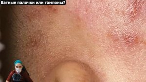Ватные палочки ИЛИ тампоны??? Чем ЛУЧШЕ удалять выдавленные выделения?