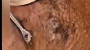 супер прыщи