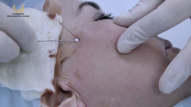 Проект Преображение.Серия 10.0. Нитевая подтяжка.