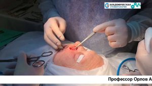 Удаление базального клеточного рака крыла носа слева