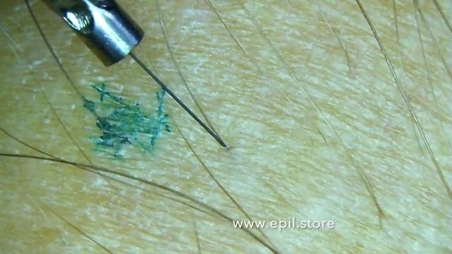 Электроэпиляция под микроскопом
