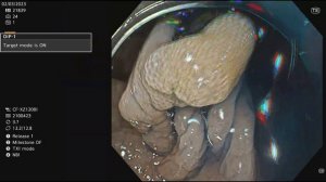 Optical diagnosis: tubular adenoma