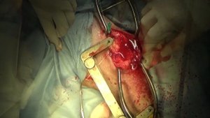 TPLO у собак при разрыве передней крестовидной связки