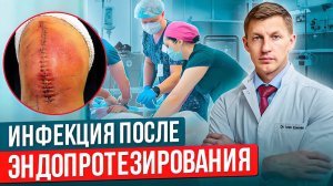 Страшные последствия после эндопротезирования. Воспаление после операции по замене сустава Нагноение