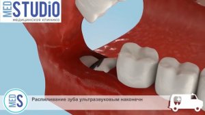Удаление зубов без боли в клинике Мед-Студио