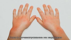 История болезни пациента с крапивницей крапивницей