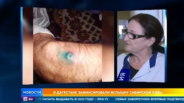 Дагестан" Вспышка Сибирской Язвы." смотреть онлайн