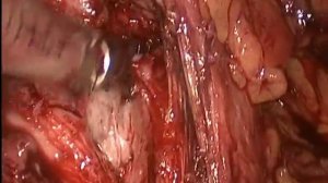 Лапароскопическая экстраперитонеальная аденомэктомия 3