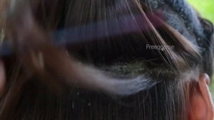 Dandruff removal ! Dandruff shampoo ll Scalp Psoriasis # 932