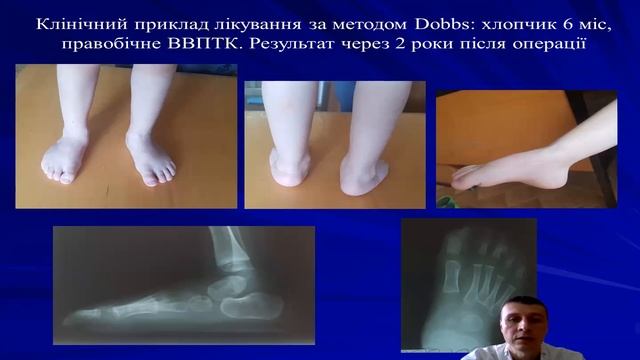Плоско-вальгусна стопа. Лікування у дітей  Flexible and Rigid Flatfoot. Surgery treatment