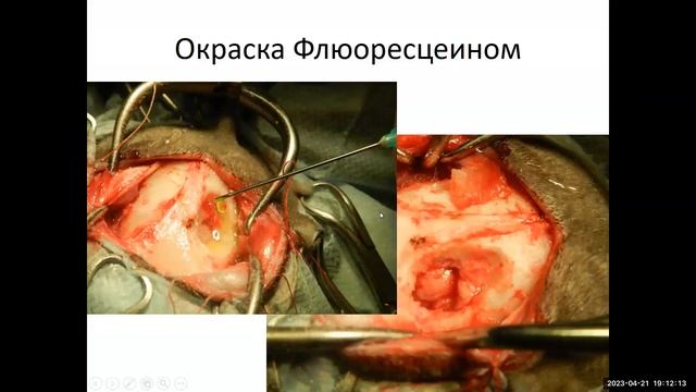 Лечение опухолей головного мозга  СД Юнси И Р
