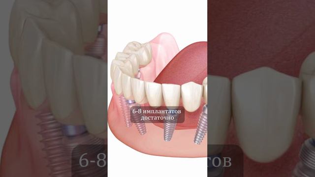 Сколько имплантов нужно, чтобы восстановить челюсть