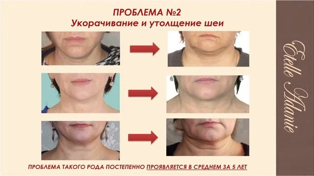 Омоложение ШЕИ / Подтянутые мышцы и эластичная кожа смотреть онлайн