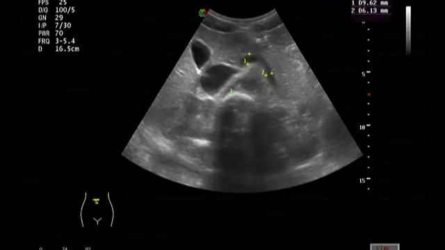 Ультразвуковая анатомия: Печень. Поджелудочная железа. Селезенка смотреть онлайн