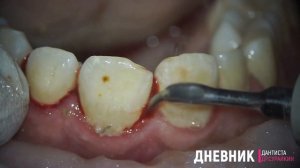 чистка зубов ультразвуком и удаление зубного камня
