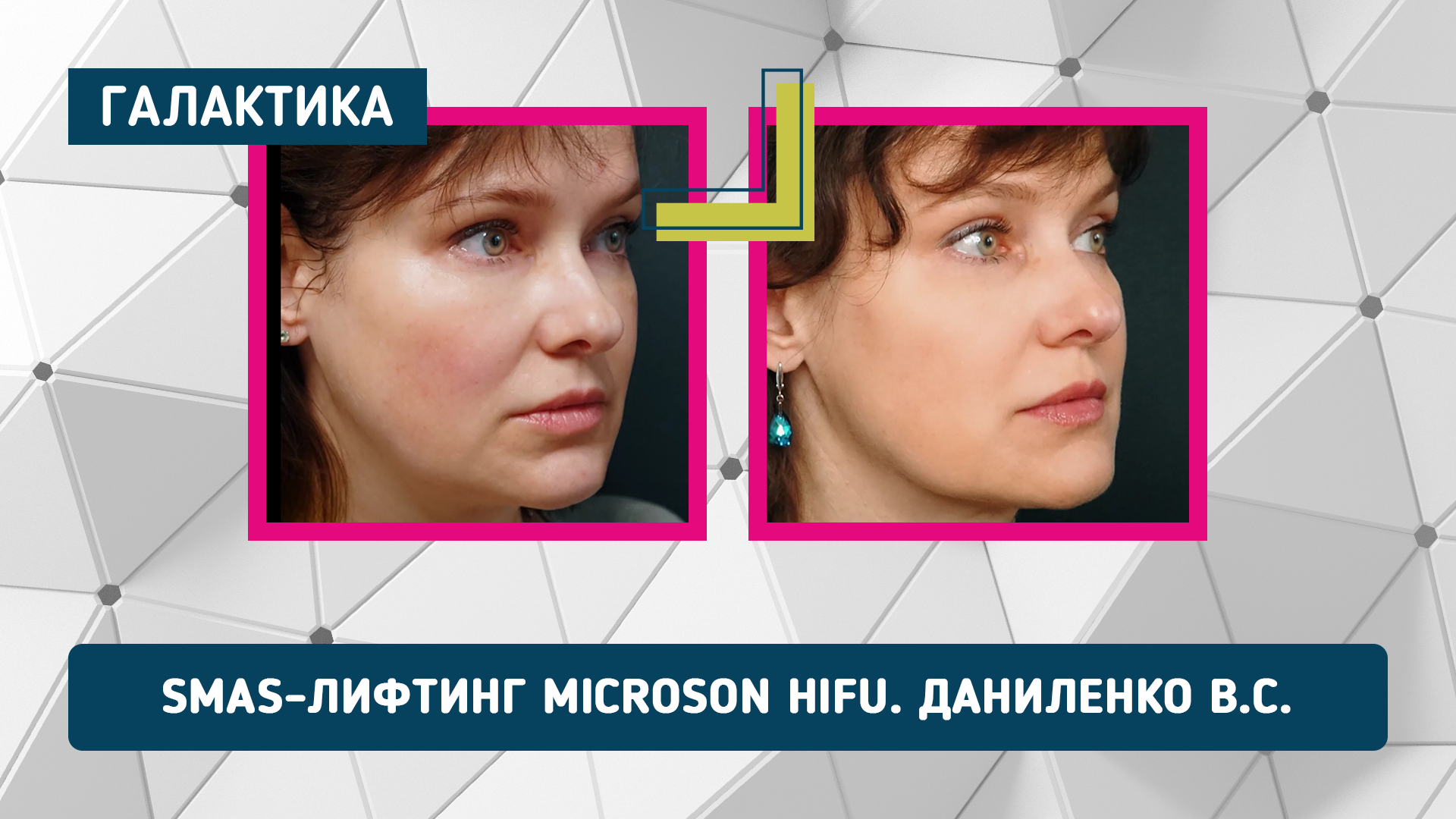 Smas-лифтинг Microson Hifu | Даниленко Василиса Сергеевна