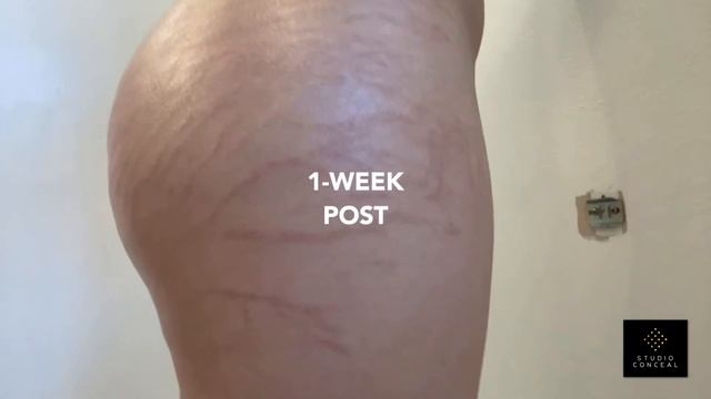 Brazilian Stretch Mark Camouflage Tattoo Healing Journey смотреть онлайн