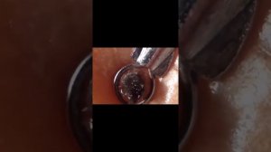 Самое залипательное видео давить прыщи Черные точки