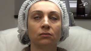 Контурная пластика губ. Определяем тактику: уменьшение или увеличение губ.