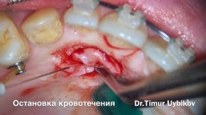 Раскрытие ретинированного клыка