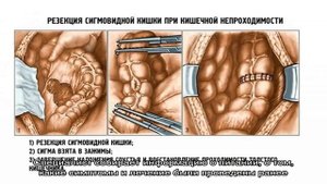 Долихосигма у ребенка