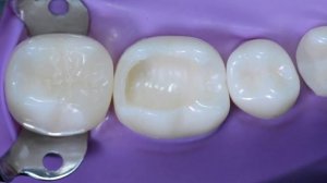 Реставрация по классу II с использованием Palodent V3